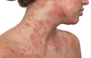 Woman´s decollete and lower face with infected skin.